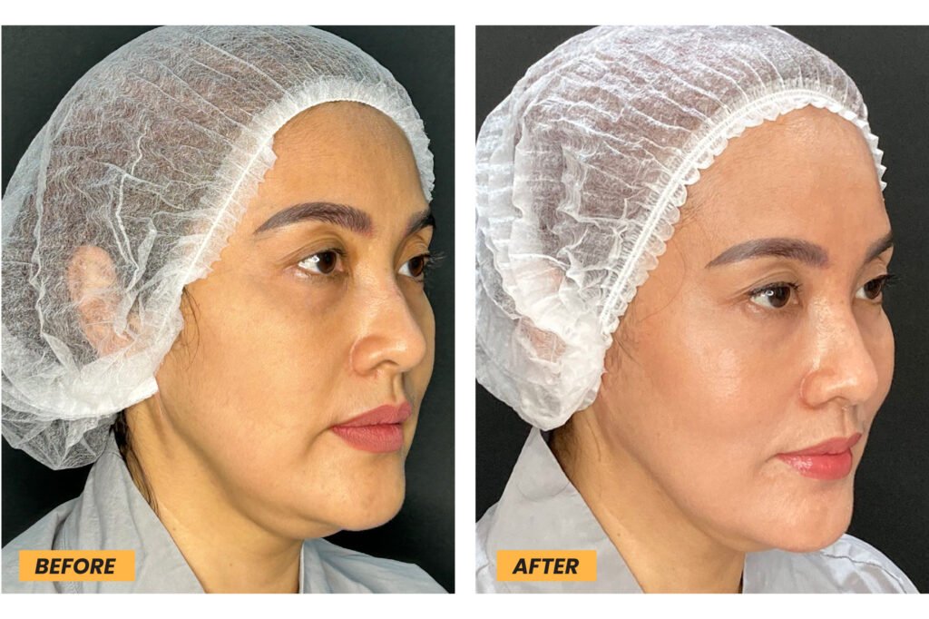 Kulit Kendur adalah proses alami di mana sel-sel kulit mati digantikan oleh sel-sel baru.